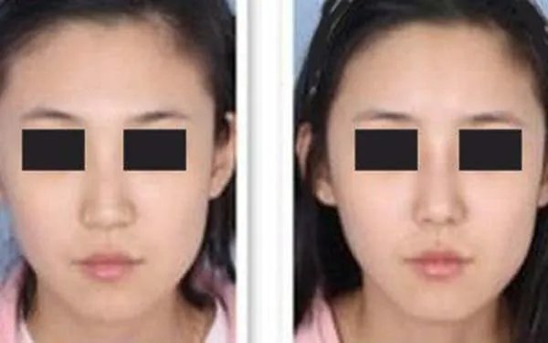 北京哪几家医院做膨体隆鼻好