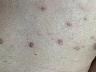 毛囊炎疙瘩图片