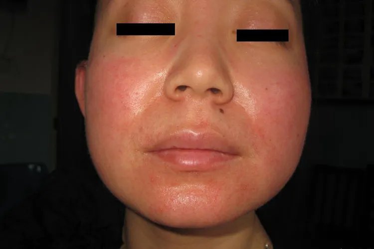 各种面部皮炎症状图片大全