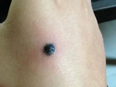 皮内痣黑痣图片