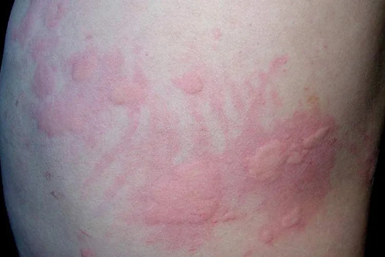 人被螨虫咬的症状图片