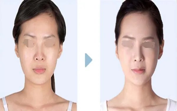 北京哪几家医院做膨体隆鼻好