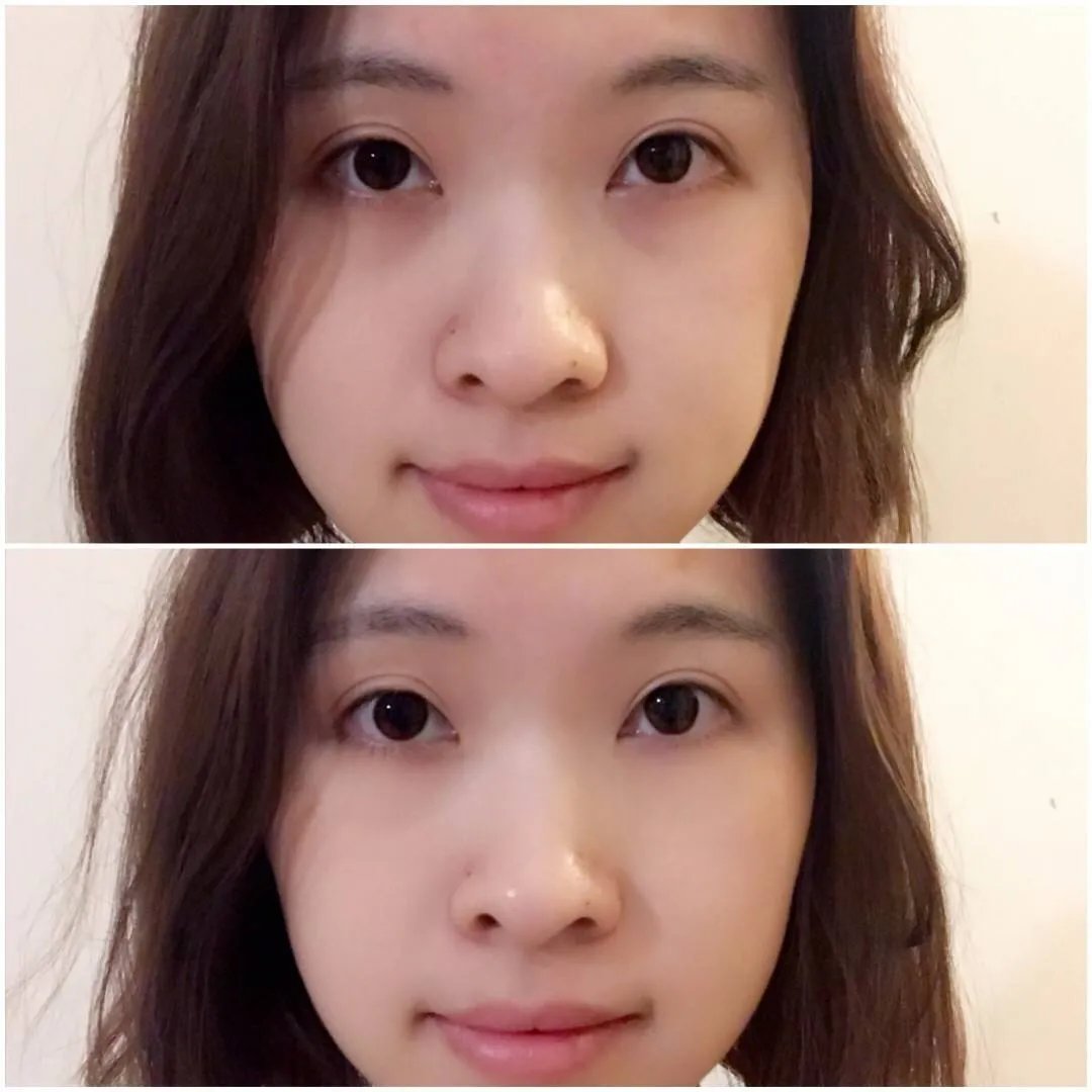 北京激光去眼袋医院哪家好?