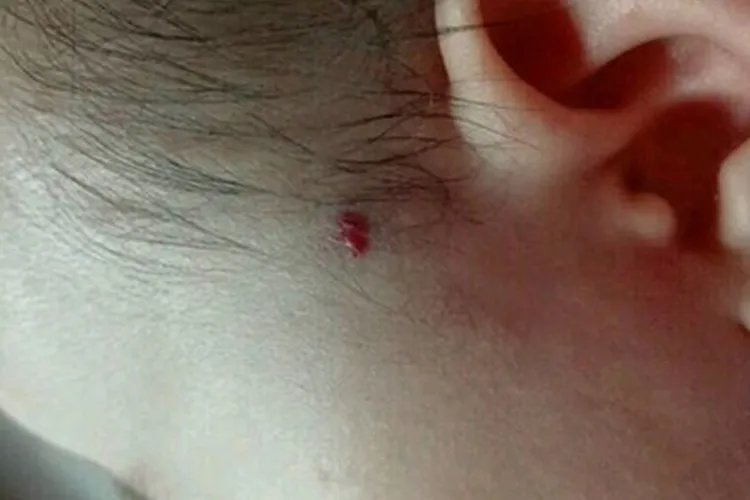 婴儿轻度血管瘤图片