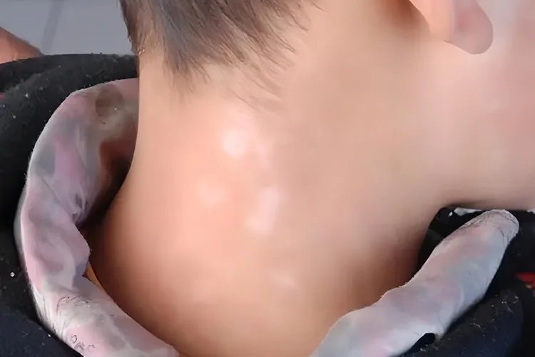 白色斑点初期症状图片