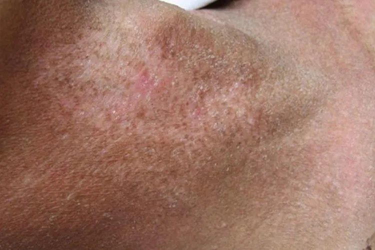 皮炎的10种症状图片