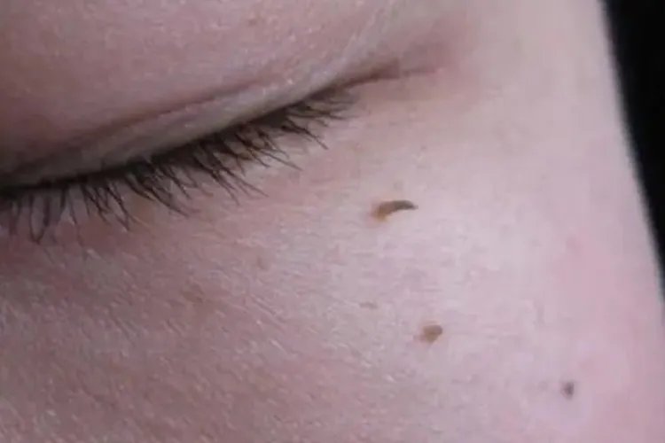 小孩长肉刺图片