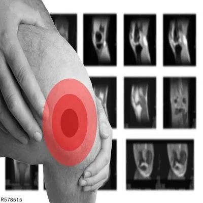 千林氢糖能治疗风湿病吗