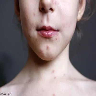 嘴巴周围长痘的原因有哪些 嘴巴长痘与7大因素脱不了关系