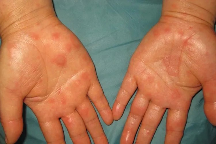 多形红斑好转的顺序图片