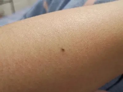 皮内痣黑痣图片