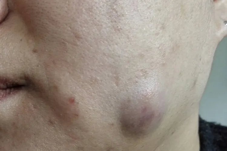 粉瘤是怎么形成的图片