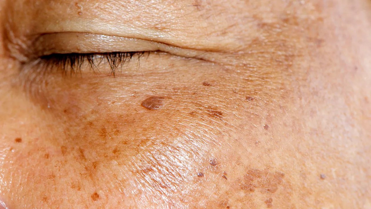 怎么祛除黄褐斑