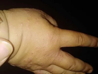 摩擦性苔藓样疹结痂图片