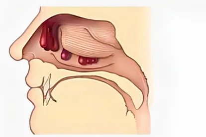 正常鼻息肉图片