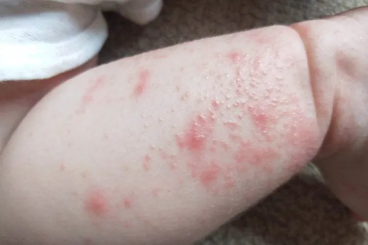 5岁孩子身上起红疙瘩很痒图片