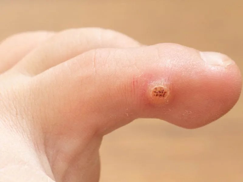 水泡脚气的病因