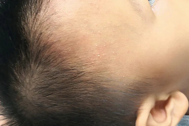 宝宝身上起痱子图片