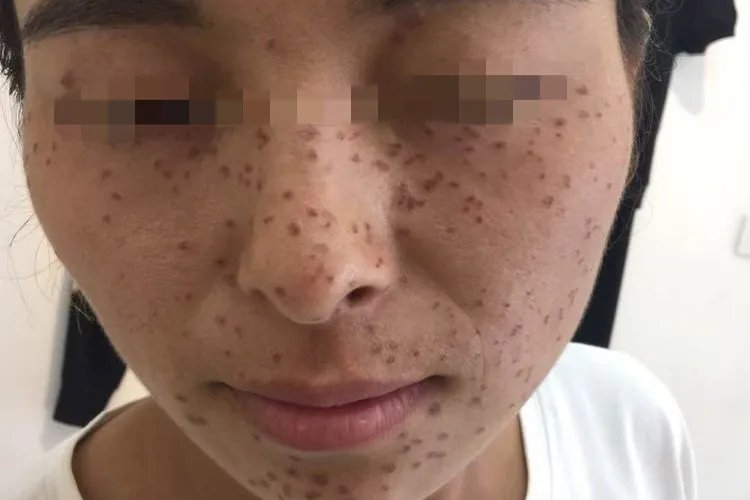 女性长斑的位置图解