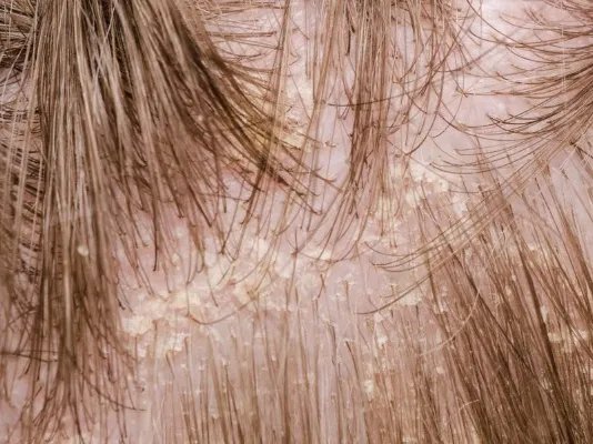 头皮疼是怎么回事