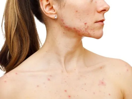 过敏性寻麻疹的病因