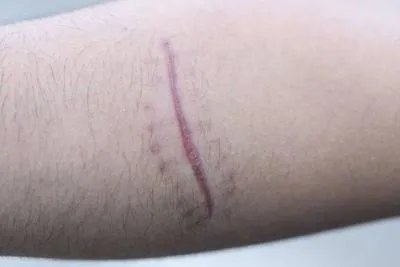 荨麻疹血管炎会留瘢痕吗