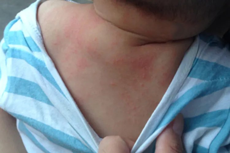 宝宝身上起痱子图片