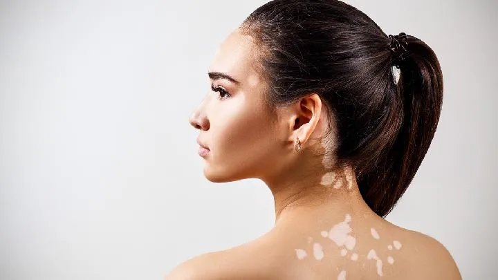 白癜风会传染吗?