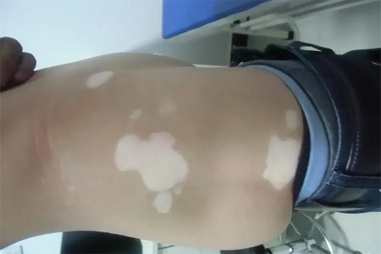 女性长斑的位置图解