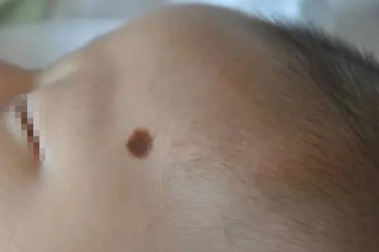 婴儿黑色素瘤早期症状图片