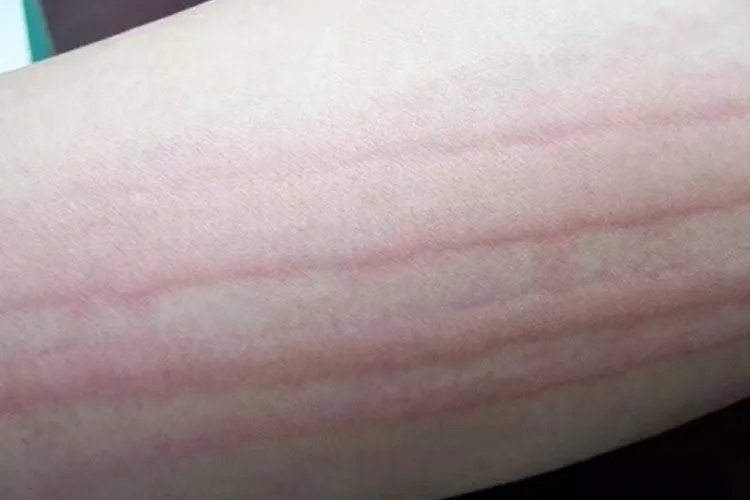 三岁小孩荨麻疹图片