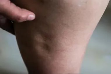 体液潴留的症状图片