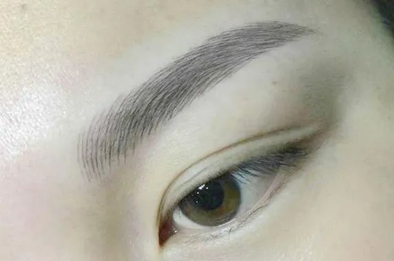 韩式三点双眼皮手术大概多少钱