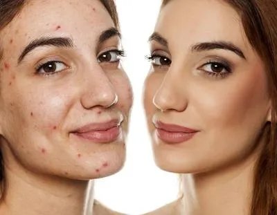 祛痘去痘印用什么好