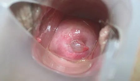 宫颈息肉图片大全