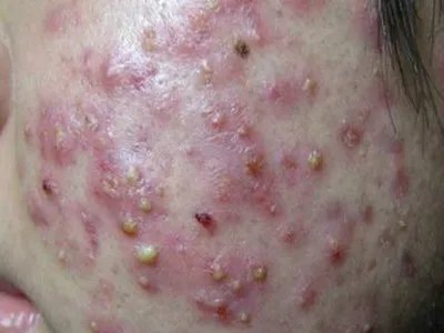 毛囊炎疙瘩图片