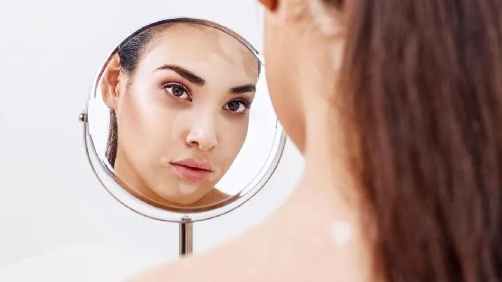 白癜风是什么病