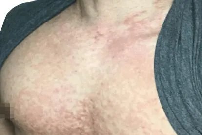 胸口长小肉粒图片