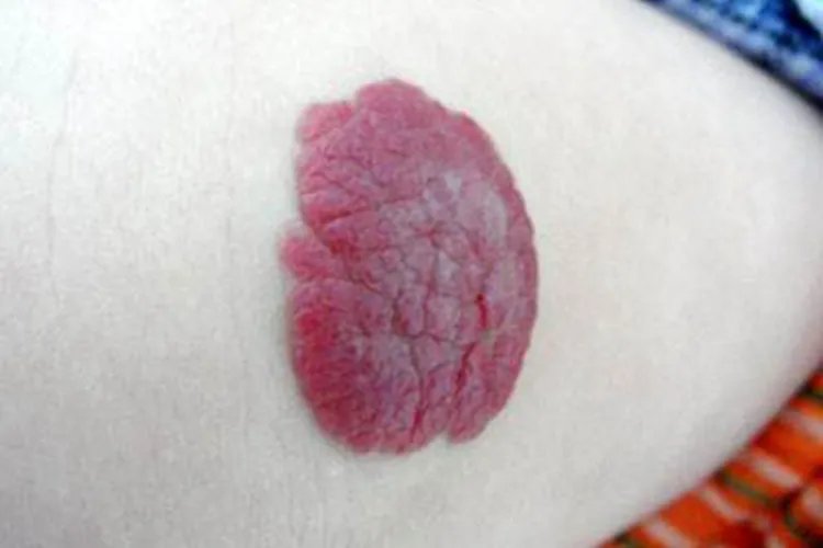 手臂上血管瘤图片