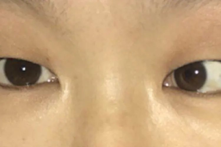 儿童斗鸡眼图片