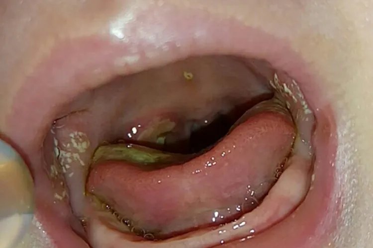 口腔白色念珠菌感染图片