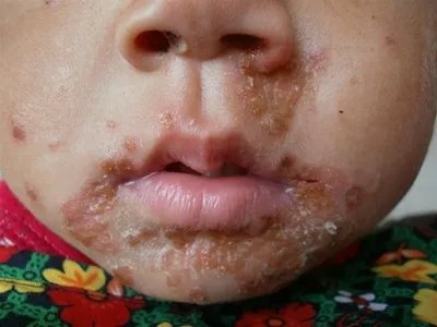 口周皮炎黄痂图片