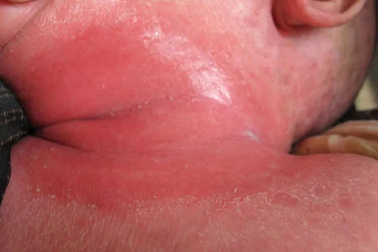 宝宝脖子念珠菌感染图片