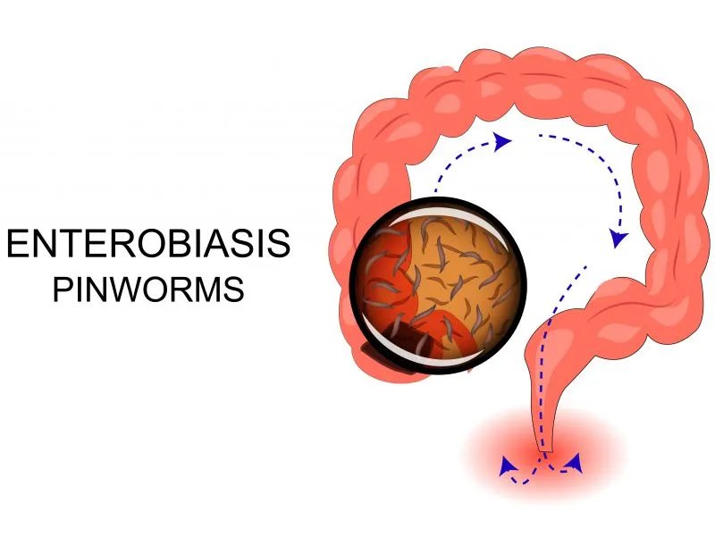 盲肠炎有什么症状