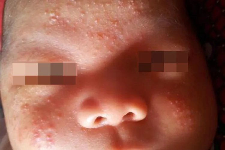 额头汗疱疹图片