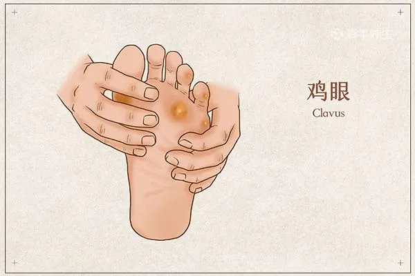 鸡眼是什么东西