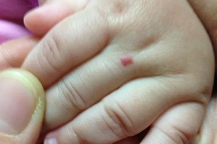 婴儿轻度血管瘤图片