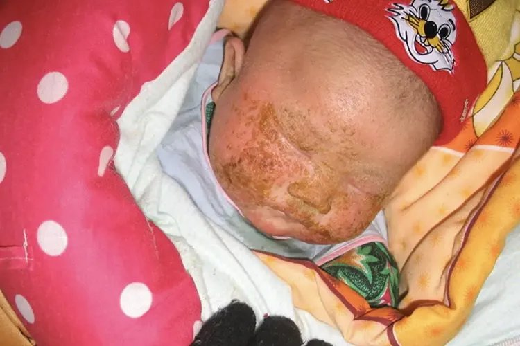 1个月婴儿湿疹图片