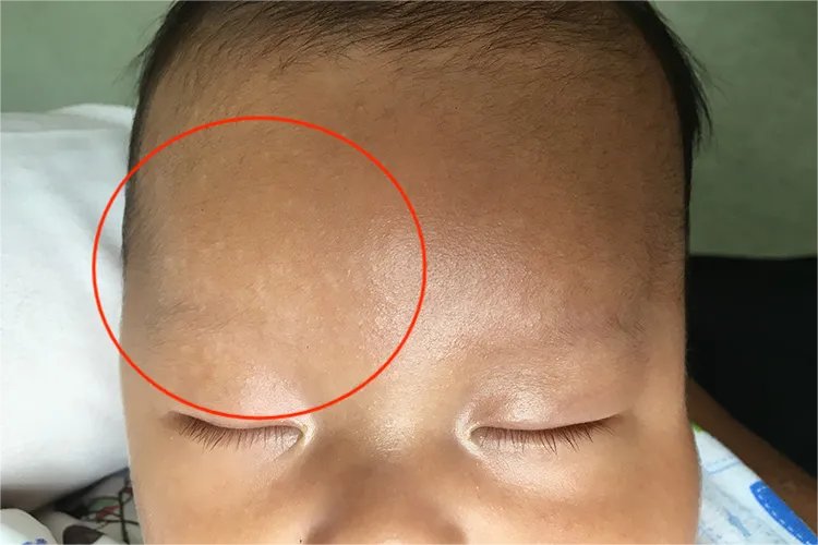 两个月宝宝汗斑图片