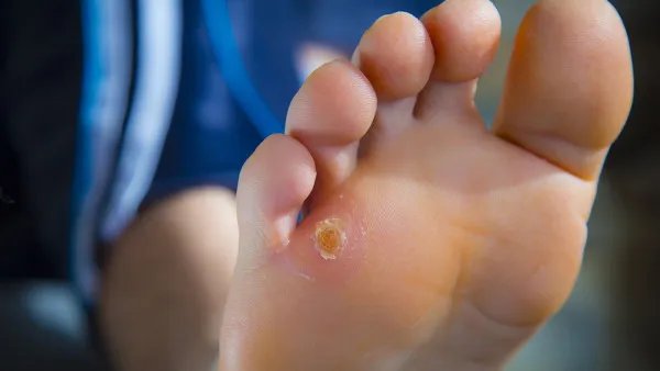 脚上起水泡怎么办